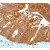 Immunohistochemistry: Sodium Potassium ATPase Alpha 1 Antibody (EP1845Y) [NB100-80005] - Immunohistochemical staining of paraffin-embedded human stomach carcinoma using Sodium Potassium ATPase Alpha 1 Antibody.